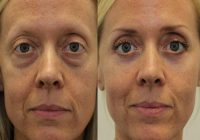 eye bag surgery