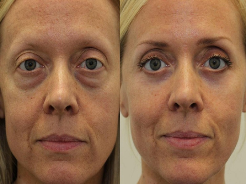 eye bag surgery